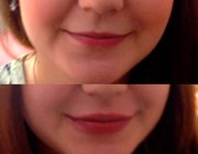 увеличение объема губ Juvederm Smile за 7500 руб - фото